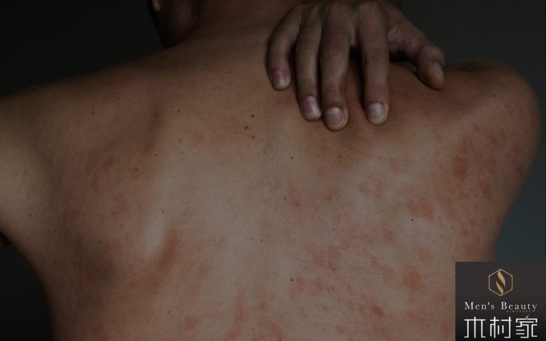 背中ニキビの意外な原因～見えないところもケアを～