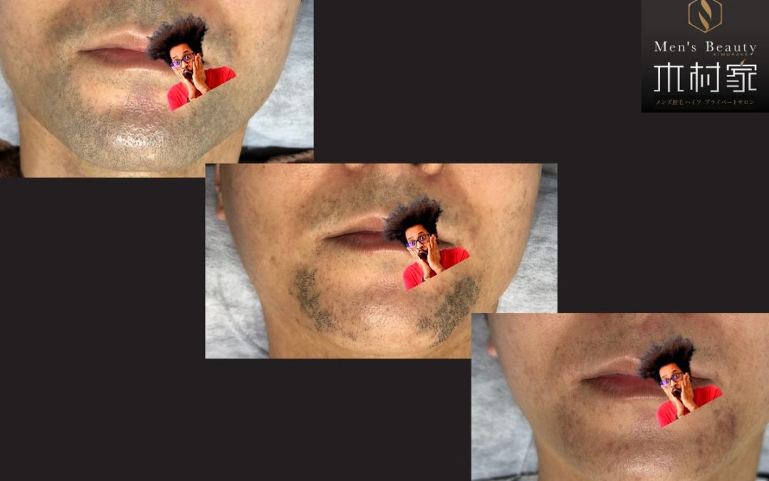 40代男性必見！こんな青ヒゲも！他サロンで抜けない毛が！