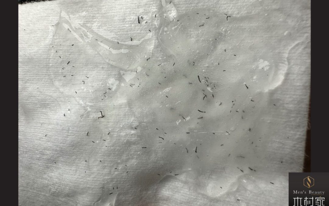 痛みに弱い方でも爆抜けします！